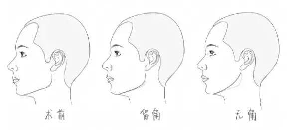 下颌角手术中决定曲线美的要素有哪些？