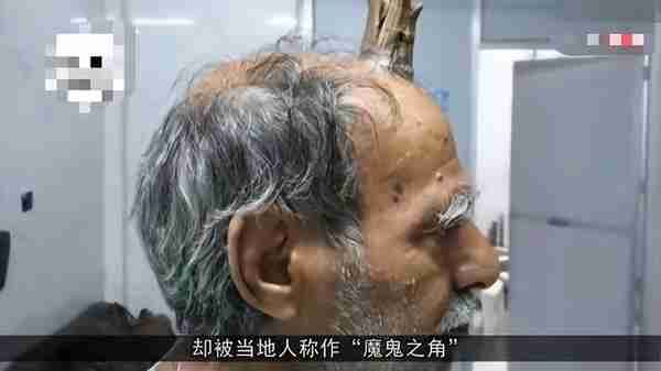 “长寿角”？广东107岁老人头上长犄角！“龙存在”又添一实证？